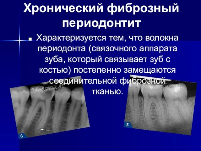 Хронический фиброзный периодонтит Характеризуется тем, что волокна периодонта (связочного аппарата зуба,