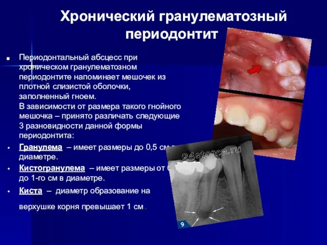 Хронический гранулематозный периодонтит Периодонтальный абсцесс при хроническом гранулематозном периодонтите напоминает мешочек