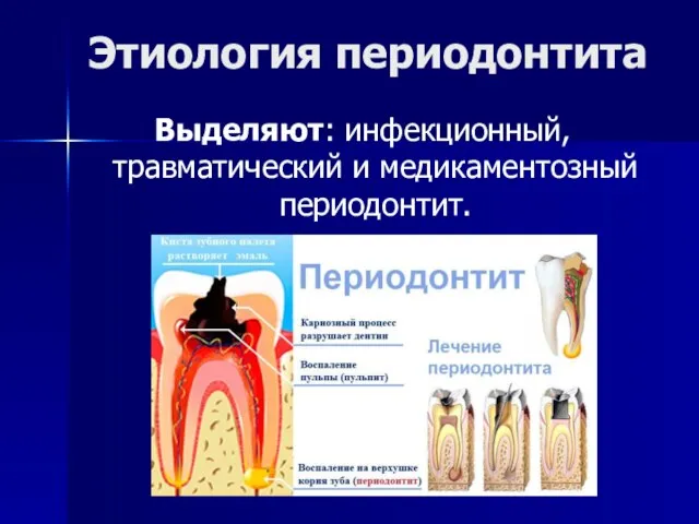 Этиология периодонтита Выделяют: инфекционный, травматический и медикаментозный периодонтит.