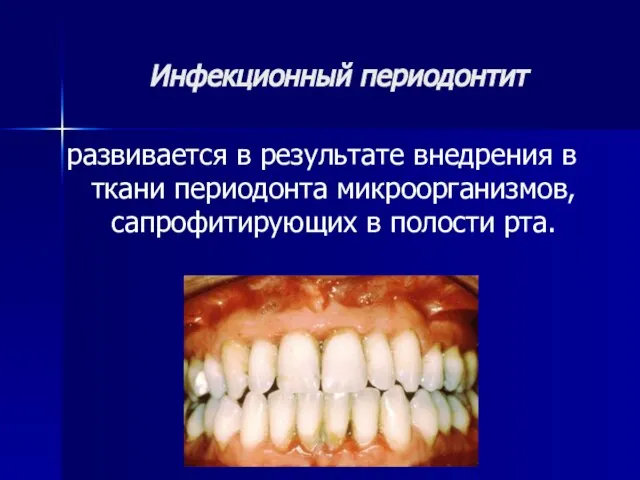 Инфекционный периодонтит развивается в результате внедрения в ткани периодонта микроорганизмов, сапрофитирующих в полости рта.