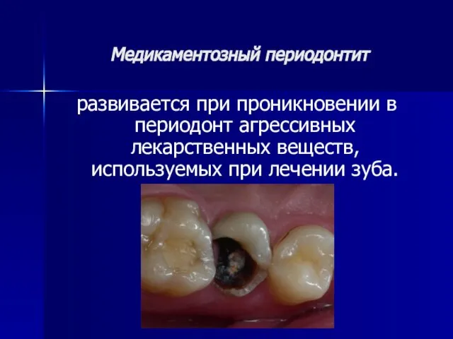 Медикаментозный периодонтит развивается при проникновении в периодонт агрессивных лекарственных веществ, используемых при лечении зуба.