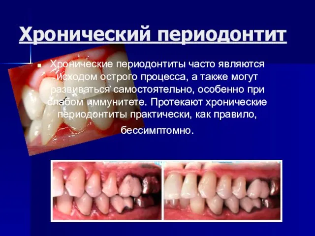 Хронический периодонтит Хронические периодонтиты часто являются исходом острого процесса, а также