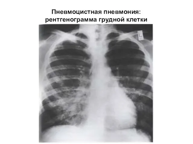 Пневмоцистная пневмония: рентгенограмма грудной клетки