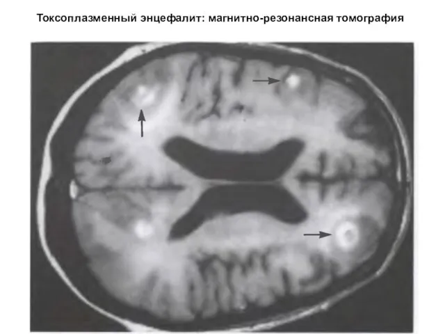 Токсоплазменный энцефалит: магнитно-резонансная томография