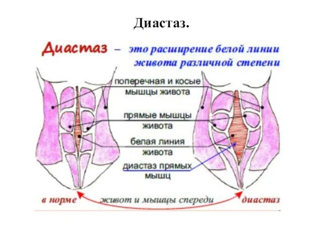 Диастаз.