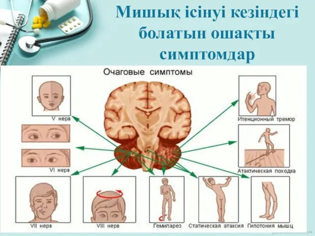 Мишық ісінуі кезіндегі болатын ошақты симптомдар