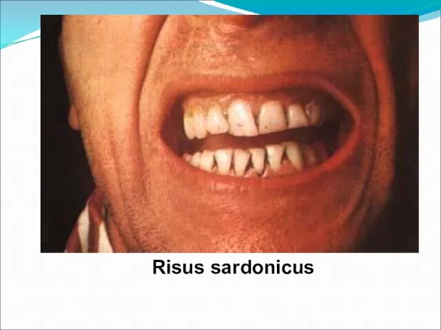 Risus sardonicus