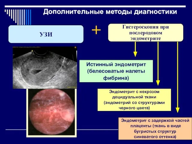 Дополнительные методы диагностики + Гистероскопия при послеродовом эндометрите УЗИ Истинный эндометрит