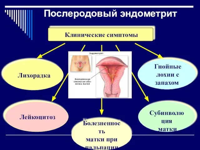 Послеродовый эндометрит Клинические симптомы Лихорадка Гнойные лохии с запахом Лейкоцитоз Субинволюция матки Болезненность матки при пальпации