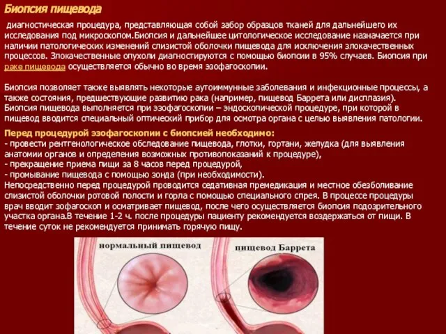 Биопсия пищевода диагностическая процедура, представляющая собой забор образцов тканей для дальнейшего