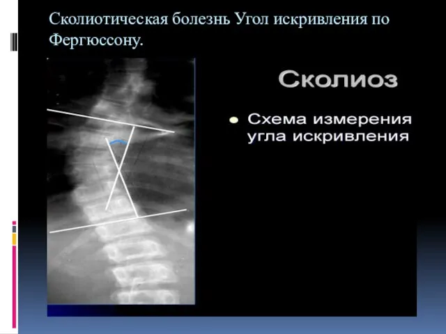 Сколиотическая болезнь Угол искривления по Фергюссону.