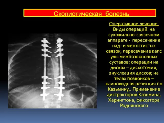 Оперативное лечение. Виды операций: на сухожильно-связочном аппарате - пересечение над- и