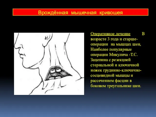 Оперативное лечение В возрасте 3 года и старше- операции на мышцах