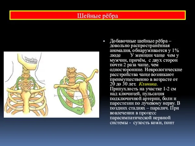 Шейные рёбра Добавочные шейные рёбра – довольно распространённая аномалия, обнаруживается у