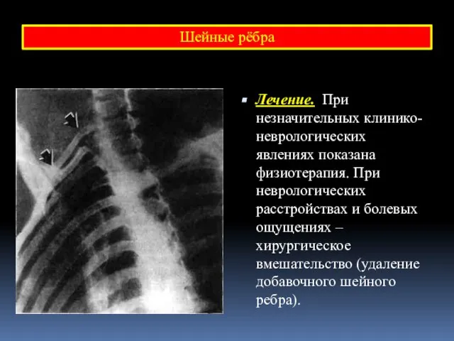 Лечение. При незначительных клинико-неврологических явлениях показана физиотерапия. При неврологических расстройствах и