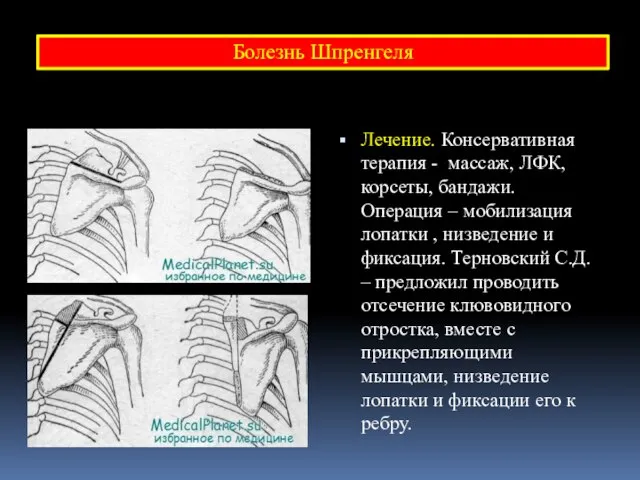 Лечение. Консервативная терапия - массаж, ЛФК, корсеты, бандажи. Операция – мобилизация