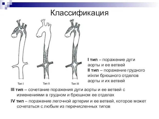 Классификация III тип – сочетание поражения дуги аорты и ее ветвей