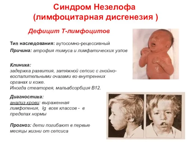 Синдром Незелофа (лимфоцитарная дисгенезия ) Дефицит Т-лимфоцитов Тип наследования: аутосомно-рецессивный Причина: