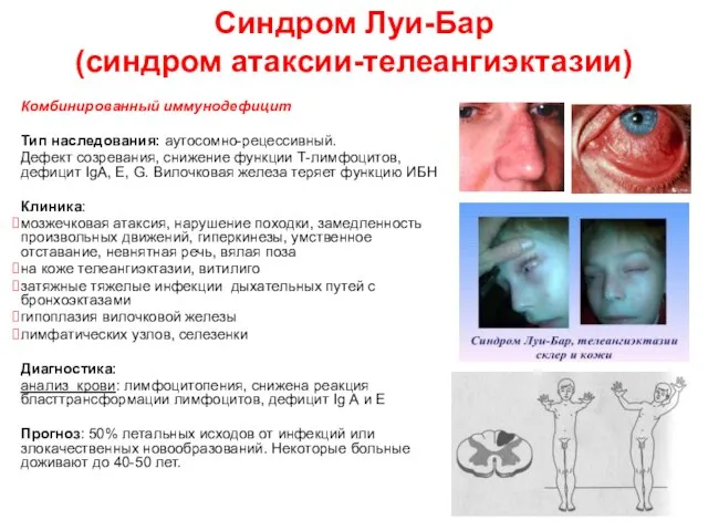 Синдром Луи-Бар (синдром атаксии-телеангиэктазии) Комбинированный иммунодефицит Тип наследования: аутосомно-рецессивный. Дефект созревания,