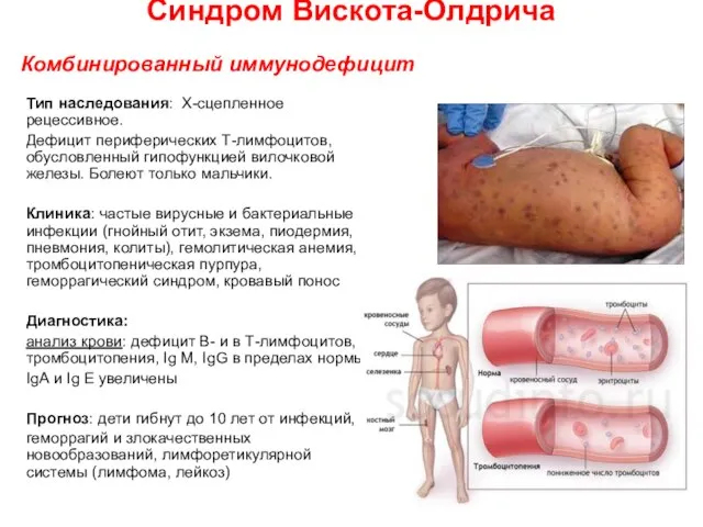 Синдром Вискота-Олдрича Тип наследования: Х-сцепленное рецессивное. Дефицит периферических Т-лимфоцитов, обусловленный гипофункцией