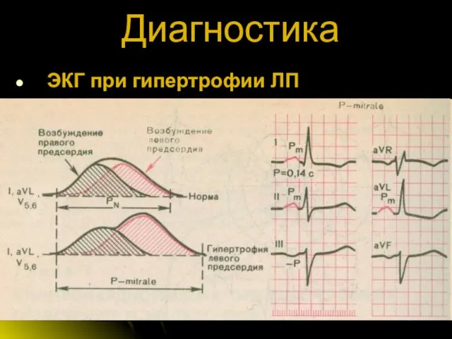 Диагностика ЭКГ при гипертрофии ЛП