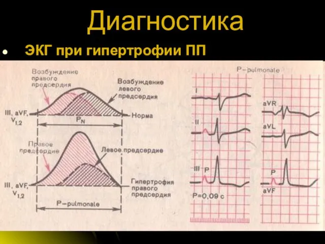 Диагностика ЭКГ при гипертрофии ПП