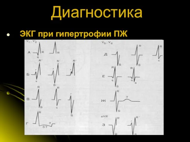 Диагностика ЭКГ при гипертрофии ПЖ