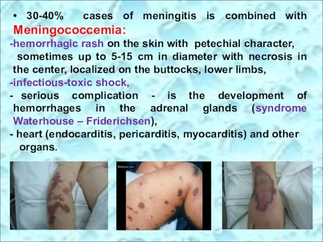 • 30-40% cases of meningitis is combined with Meningococcemia: hemorrhagic rash