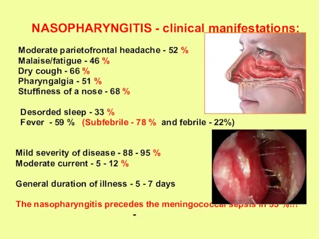 NASOPHARYNGITIS - clinical manifestations: Moderate parietofrontal headache - 52 % Malaise/fatigue