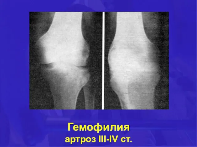 Гемофилия артроз III-IV ст.