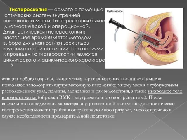 Гистероскопия — осмотр с помощью оптических систем внутренней поверхности матки. Гистероскопия
