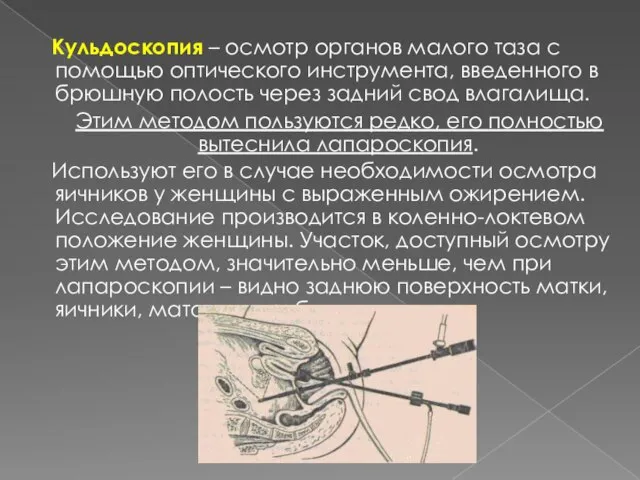 Кульдоскопия – осмотр органов малого таза с помощью оптического инструмента, введенного