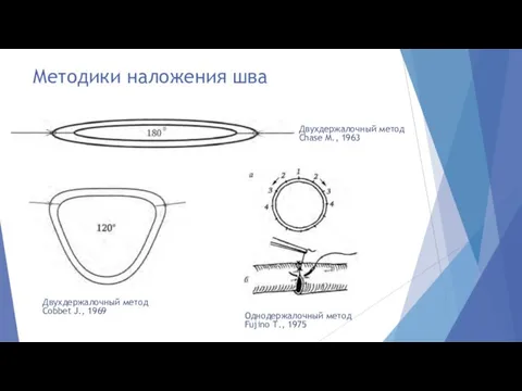 Методики наложения шва Однодержалочный метод Fujino Т., 1975 Двухдержалочный метод Chase