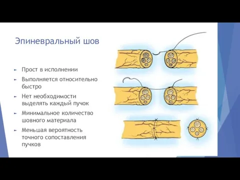 Эпиневральный шов Прост в исполнении Выполняется относительно быстро Нет необходимости выделять