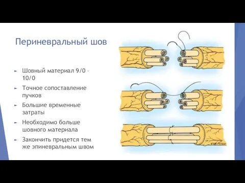 Периневральный шов Шовный материал 9/0 – 10/0 Точное сопоставление пучков Большие