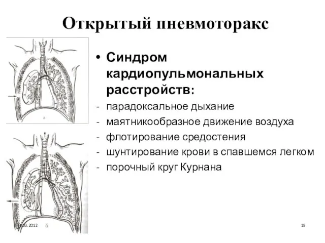 Открытый пневмоторакс Синдром кардиопульмональных расстройств: парадоксальное дыхание маятникообразное движение воздуха флотирование