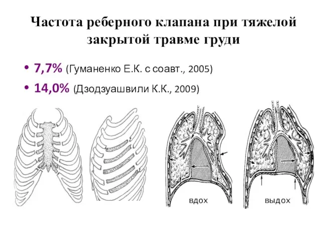 Частота реберного клапана при тяжелой закрытой травме груди 7,7% (Гуманенко Е.К.