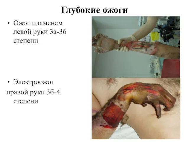 Глубокие ожоги Ожог пламенем левой руки 3а-3б степени Электроожог правой руки 3б-4 степени