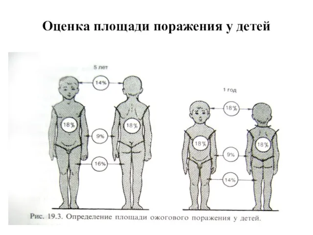 Оценка площади поражения у детей