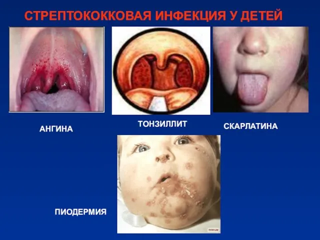 СТРЕПТОКОККОВАЯ ИНФЕКЦИЯ У ДЕТЕЙ ПИОДЕРМИЯ СКАРЛАТИНА АНГИНА ТОНЗИЛЛИТ