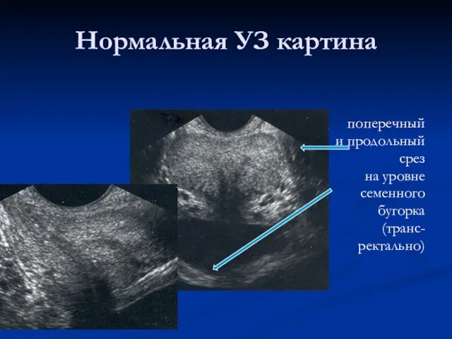 Нормальная УЗ картина поперечный и продольный срез на уровне семенного бугорка (транс- ректально)