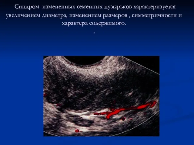 Синдром измененных семенных пузырьков характеризуется увеличением диаметра, изменением размеров , симметричности и характера содержимого. .