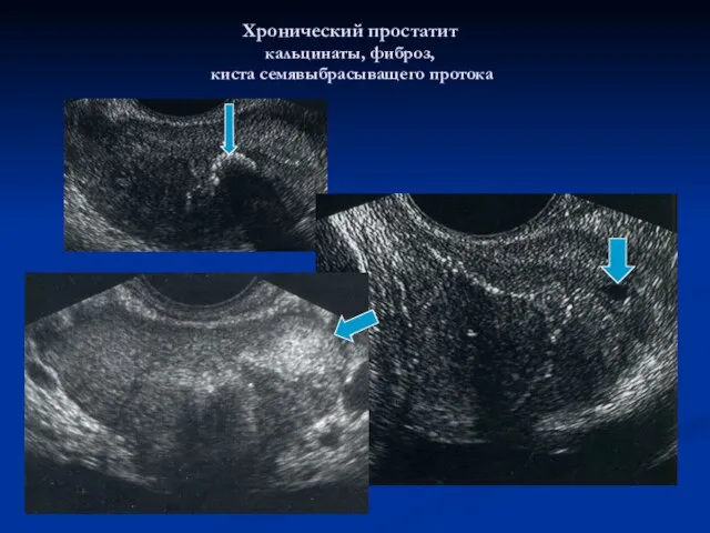 Хронический простатит кальцинаты, фиброз, киста семявыбрасыващего протока