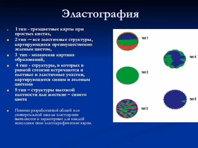 Эластография 1 тип - трехцветные карты при простых кистах, 2 тип