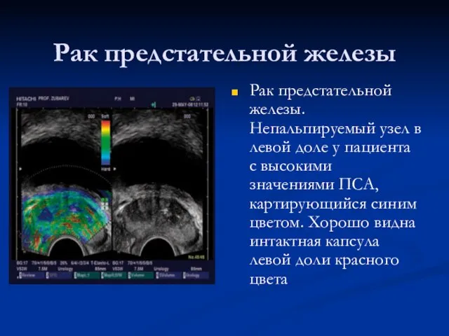 Рак предстательной железы Рак предстательной железы. Непальпируемый узел в левой доле