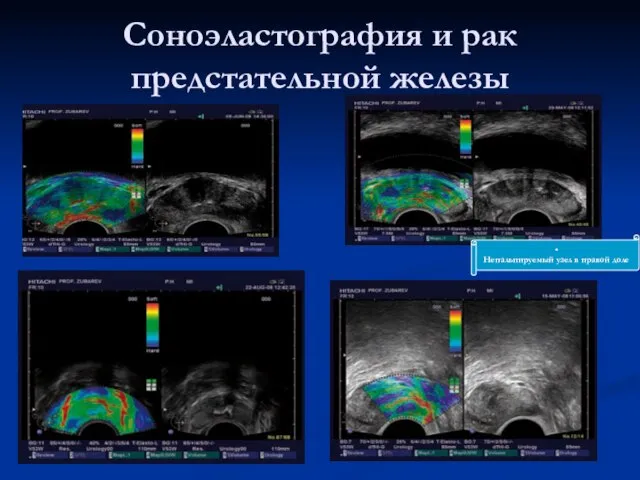 Соноэластография и рак предстательной железы . Непальпируемый узел в правой доле