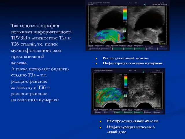 Так соноэластография повышает информативность ТРУЗИ в диагностике Т2а и Т2б стадий,