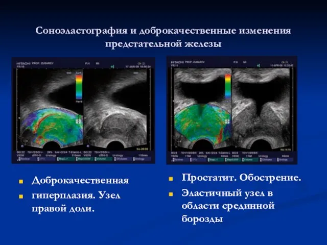 Соноэластография и доброкачественные изменения предстательной железы Доброкачественная гиперплазия. Узел правой доли.