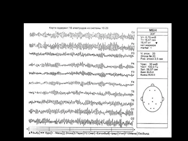 Визуальный анализ ЭЭГ