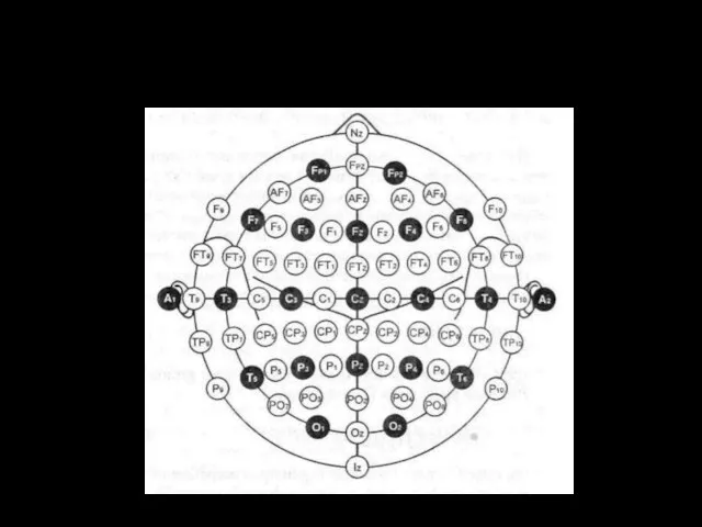 Система расположения электродов 10 – 10 (черным – 10 – 20)